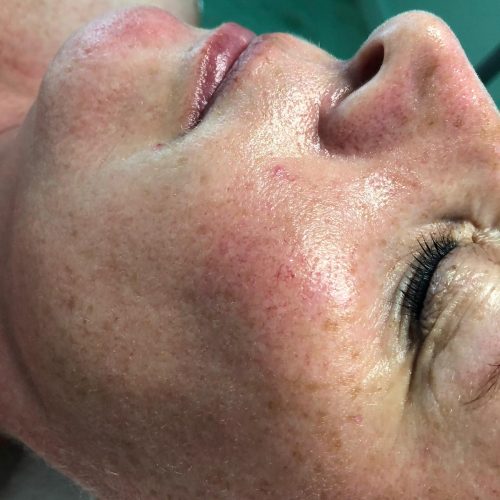 renate collageen softening na