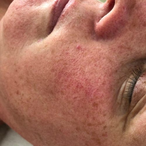 renate collageen softening voor